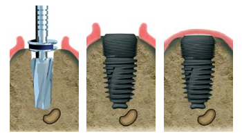 Implants dentaires Paris 11